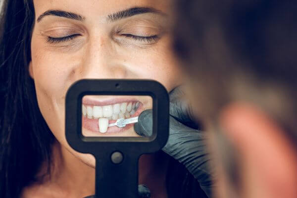 faccette dentali correzzola dental center